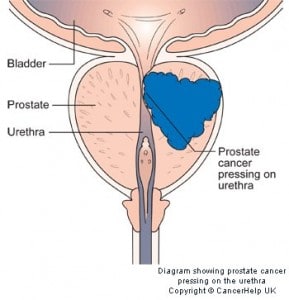 diagram showing prostate cancer pressing on the urethra