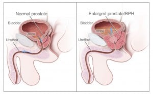 image of an enlarged prostate vs a normal prostate