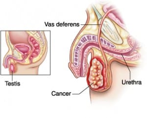 image showing symptoms of testicular cancer