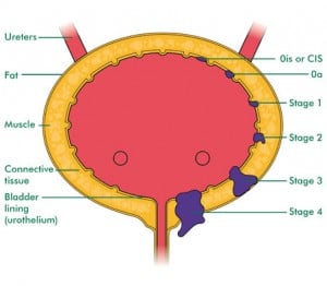 bladder cancer stages via macmillan.org.uk