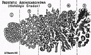 image of histologic grades by Dr Gleason via www.usrf.org