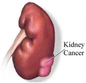 kidney cancer image via aboutcancer.com